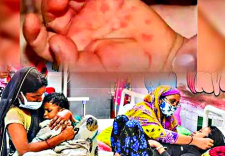 Rajčatová horečka v Indii: co to je, jaké jsou příznaky, jak se přenáší a kdo je postižen?
