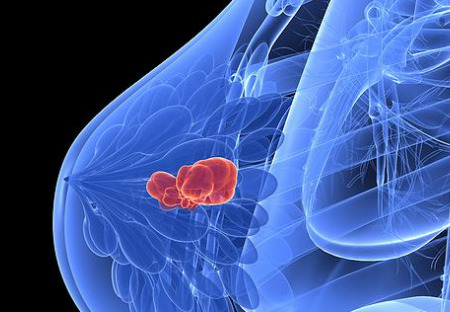 1,3 miliónu žen chybně léčeno kvůli falešně pozitivním výsledkům z mamogramů